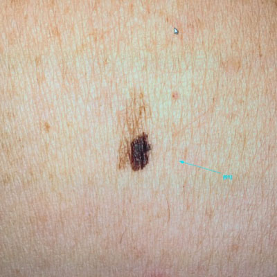 Dermoscopie de carcinome basocellulaire