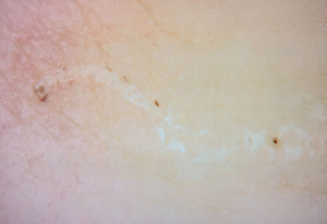 Gale : dermatoscopie du parasite &agrave; l&rsquo;extr&eacute;mit&eacute; d&rsquo;un sillon