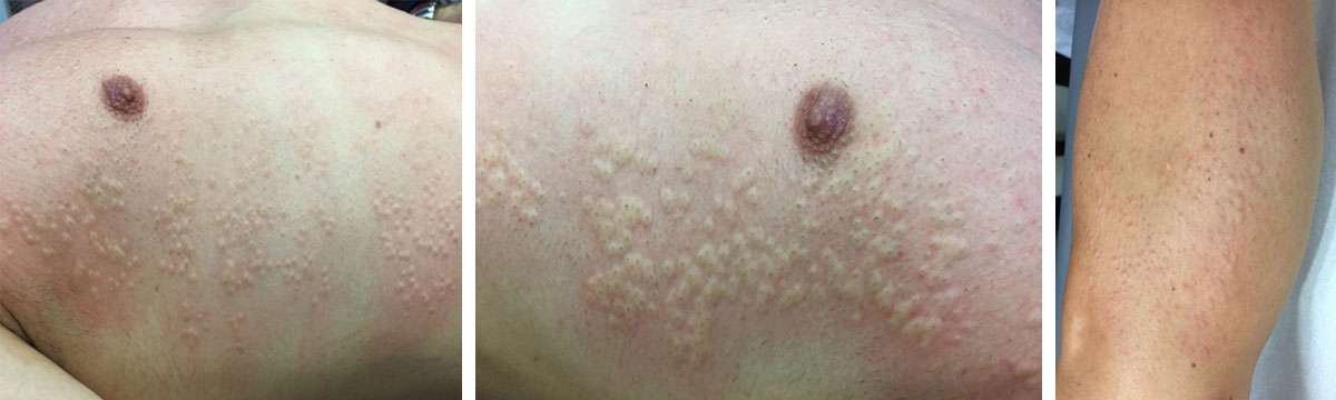 Petits gonflements des follicules pileux apr&egrave;s une &eacute;pilation laser
